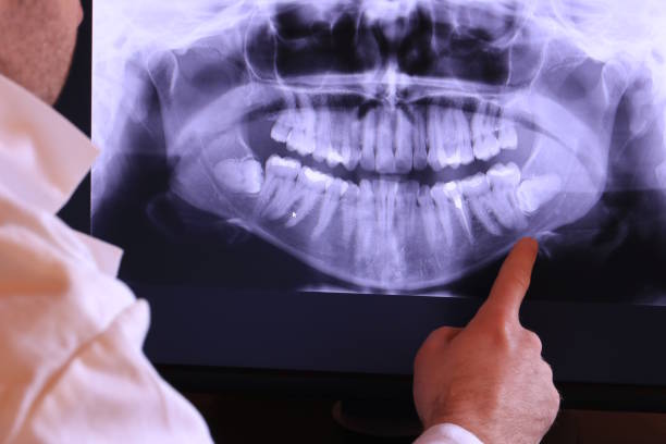 Best Emergency Wisdom Teeth Removal in Chaffee, MO